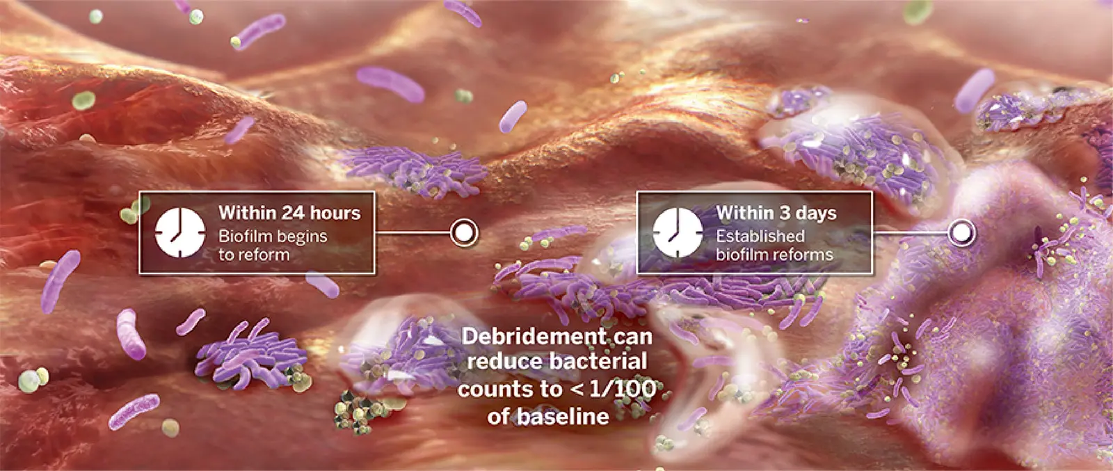 DEBRIDEMENT ALONE IS NOT ENOUGH