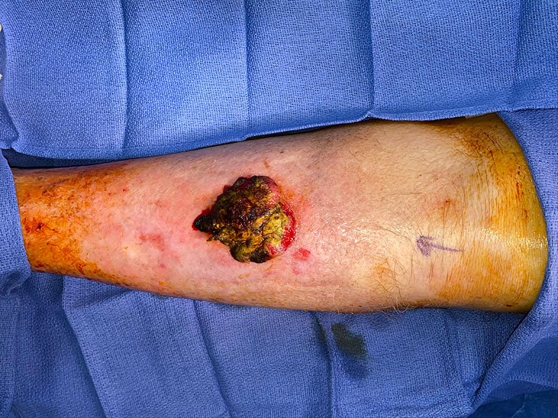 Leg tumor excision site